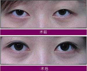 北京协和医院黄渭清割双眼皮案例