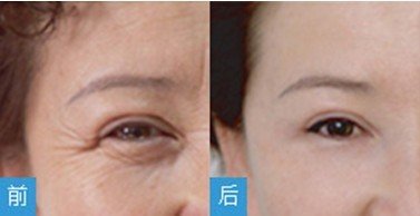 北医三院整形外科毕洪森除皱案例