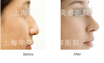 上海华美整形医院李庭勋隆鼻案例图