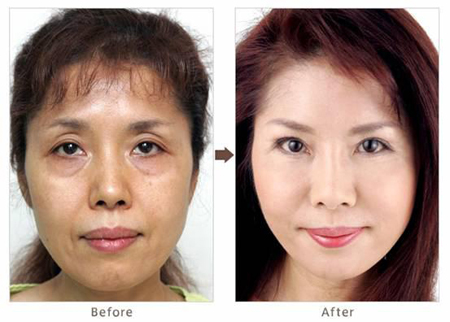 北京玉之光蔡文静面部除皱案例