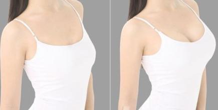 上海华美李健假体隆胸案例图