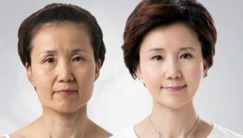 北京航空总医院韩勋超声提拉除皱案例 北京航空总医院韩勋超声提拉除皱案例