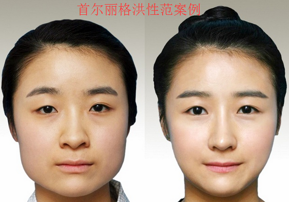 上海首尔丽格洪性范下颌角磨骨案例 上海首尔丽格洪性范下颌角磨骨案例