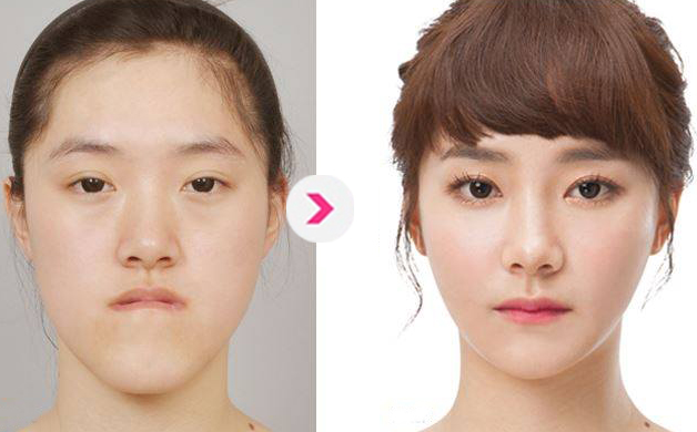 上海首尔丽格洪性范整形案例 上海首尔丽格洪性范整形案例