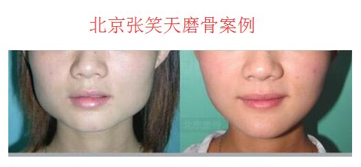 张笑天下颌角磨骨案例 张笑天下颌角磨骨案例