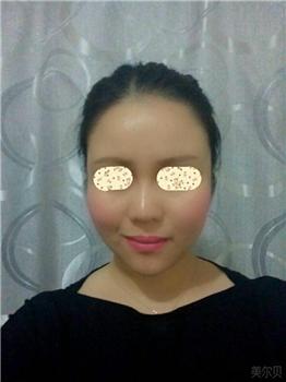 张笑天术后照片 张笑天术后案例