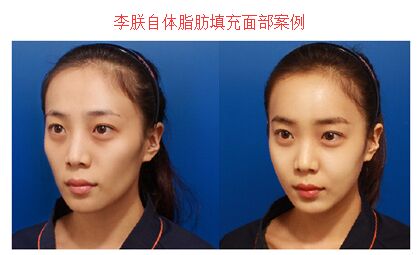 北京李朕面部填充案例 北京李朕面部填充案例