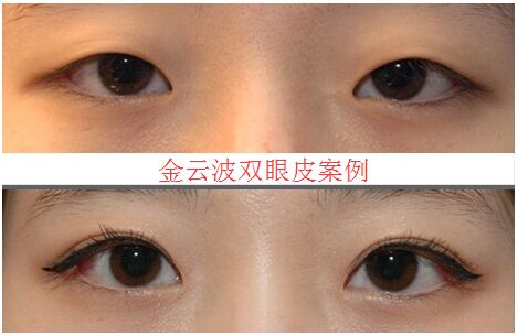 上海九院金云波割双眼皮案例 上海九院金云波割双眼皮案例