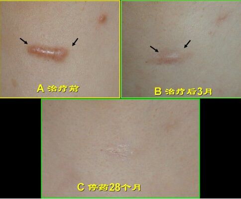 上海九院武晓莉疤痕修复案例 上海九院武晓莉疤痕修复案例