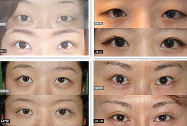 北京俯大清采双眼皮案例 北京俯大清采双眼皮案例