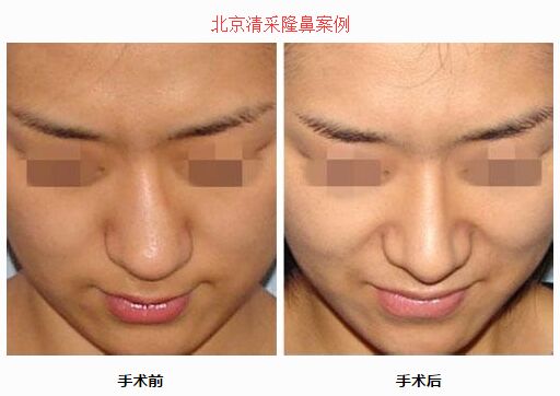 北京俯大赵翊利隆鼻案例