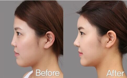 上海九院陈付国隆鼻案例 上海九院陈付国隆鼻案例