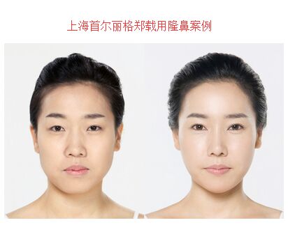 上海首尔丽格郑载用隆鼻案例 上海首尔丽格郑载用隆鼻案例