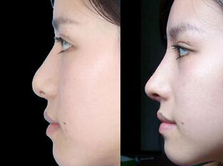 北京韩式隆鼻手术价格是多少钱?