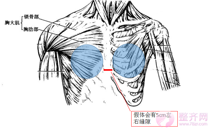 3,希望有乳沟,因为假体只能放胸大肌指点之外,中间间隔5cm~6cm,要想有