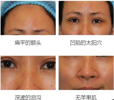 北京玉之光脂肪填充案例 北京玉之光脂肪填充案例