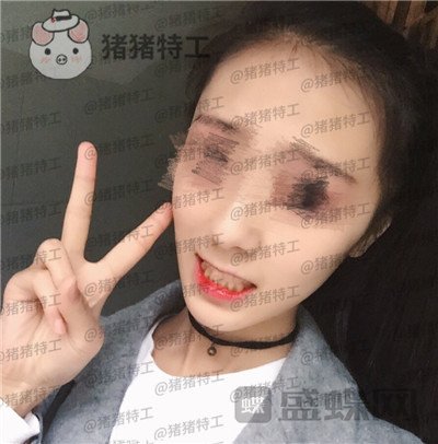成都博爱,李竞男,牙齿美白,案例,价格,