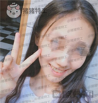 成都博爱,李竞男,牙齿美白,案例,价格,