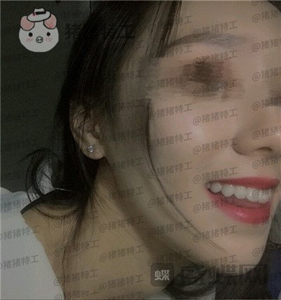成都博爱,李竞男,牙齿美白,案例,价格,